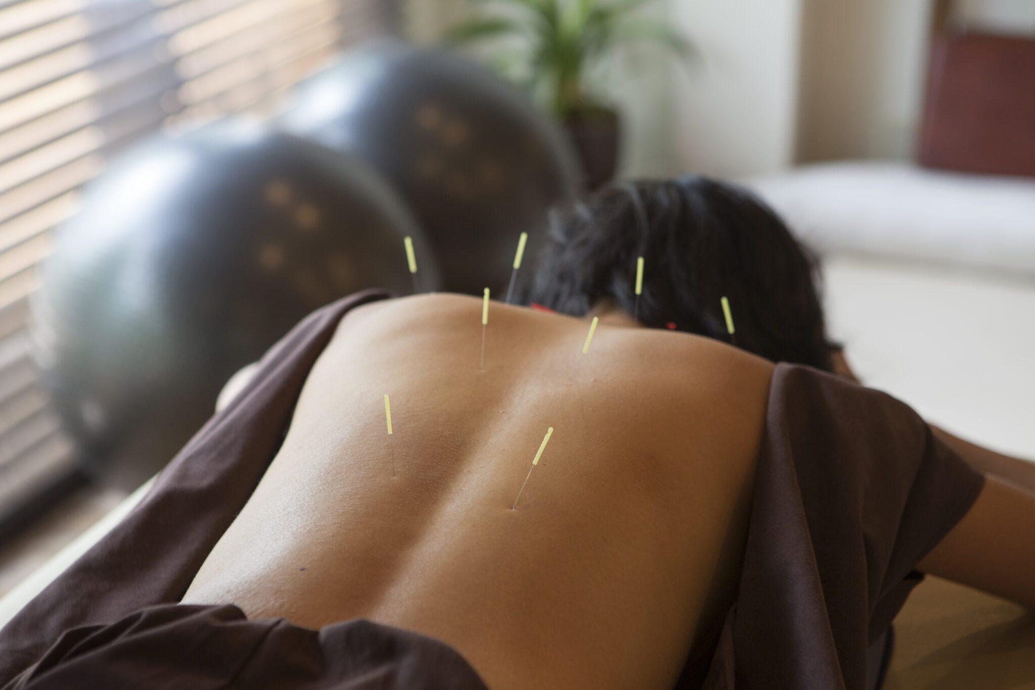 Acupuncture